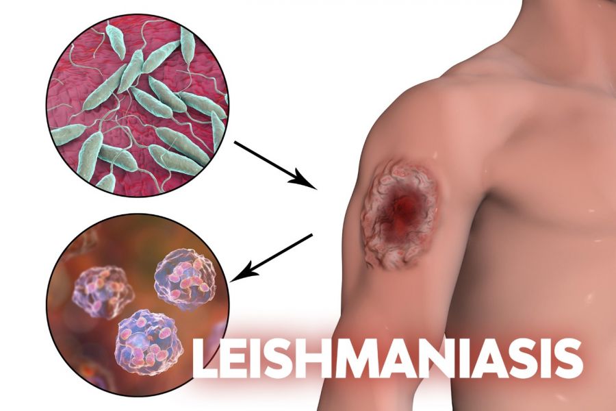 La leishmaniasis es una enfermedad parasitaria diseminada por la picadura de un mosquito infectado.