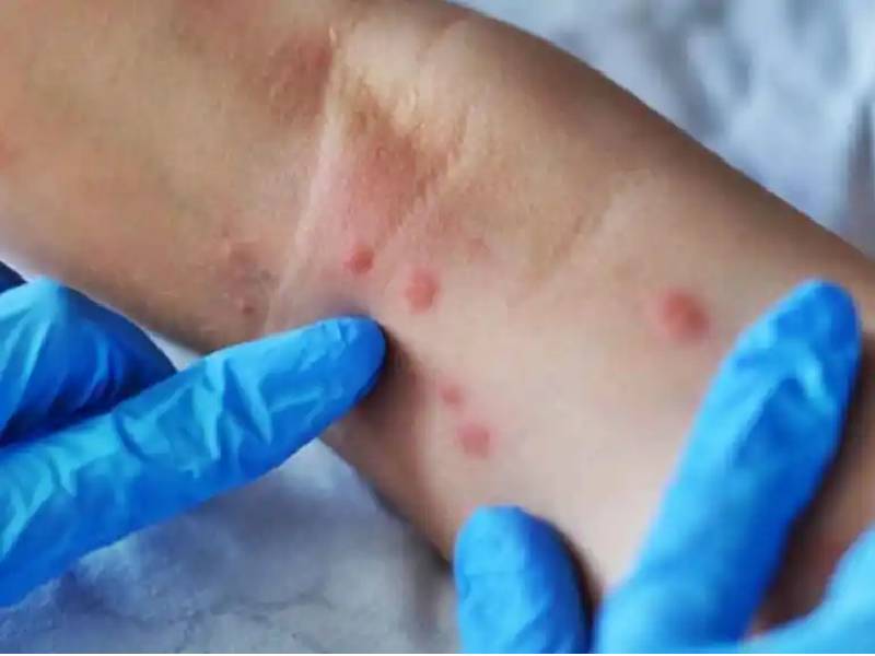 Se confirma segundo caso de viruela símica en la CDMX