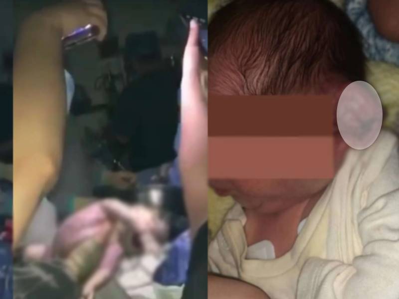 Médicos se quedan sin luz en plena cesárea; le cortan la oreja a bebé